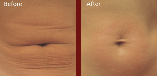 spa forma plus before and after belly