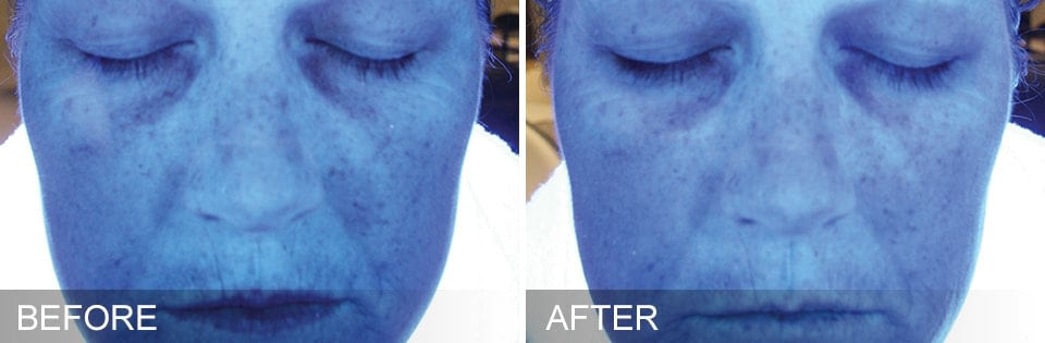 HYDRAFACIAL before after 6