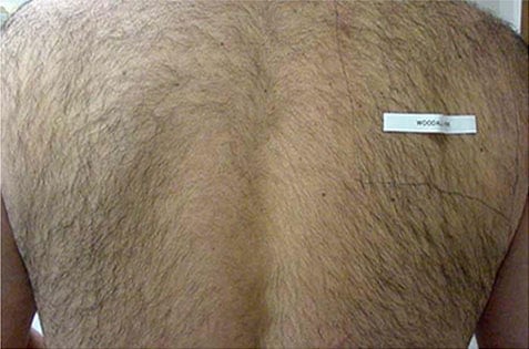 LASER HAIR REMOVAL BEFORE 1