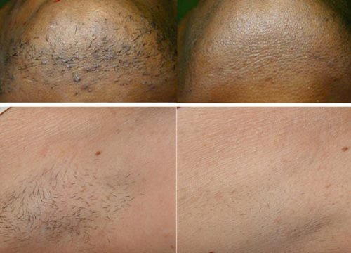 laser hair removal 500x360