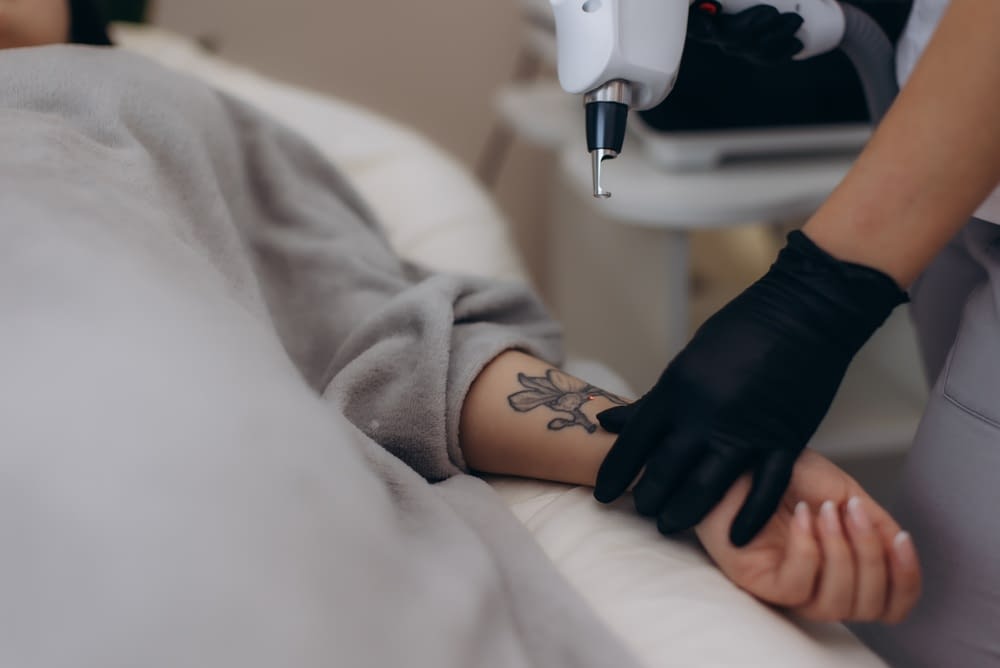 Laser Tattoo Removal Work