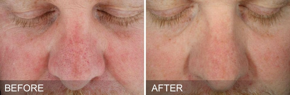 HYDRAFACIAL before after 5