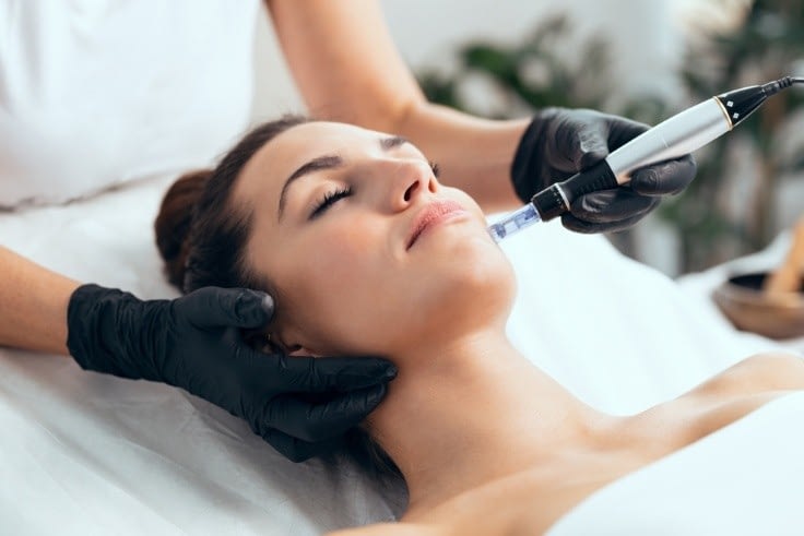 Tired of Filters Microneedling Might Be Your Real Life Skin Smoother!