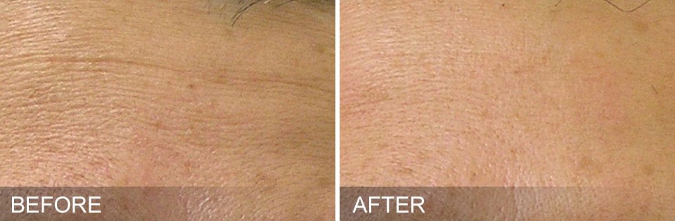 HYDRAFACIAL before after 4
