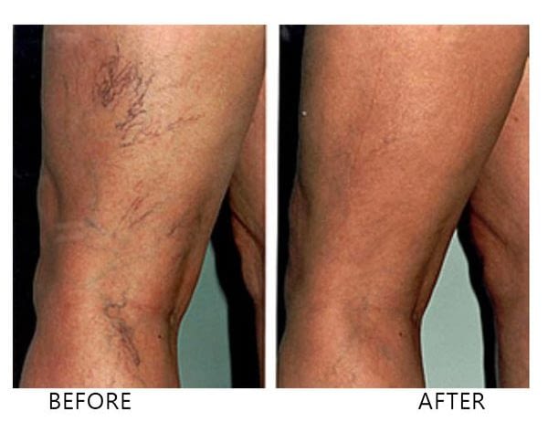 Laser Vein Treatment Mississauga - Skincare Laser Centre