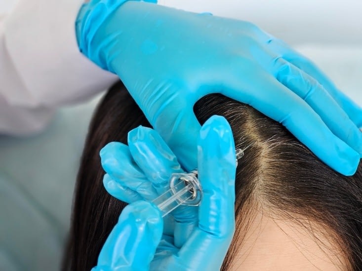 The Overlooked Advantages of PRP Injections for Hair Loss