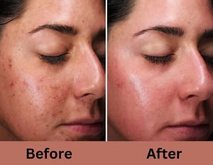 skincarelasercentre -hydrafacial treatment for acne