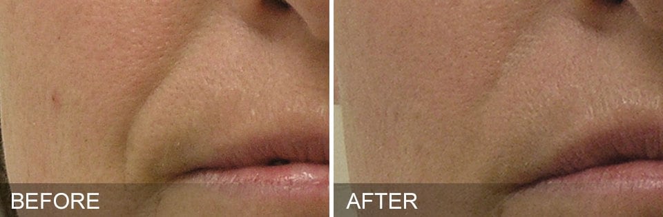 HYDRAFACIAL before after 2