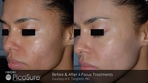 Hyperpigmentation Treatment for Face