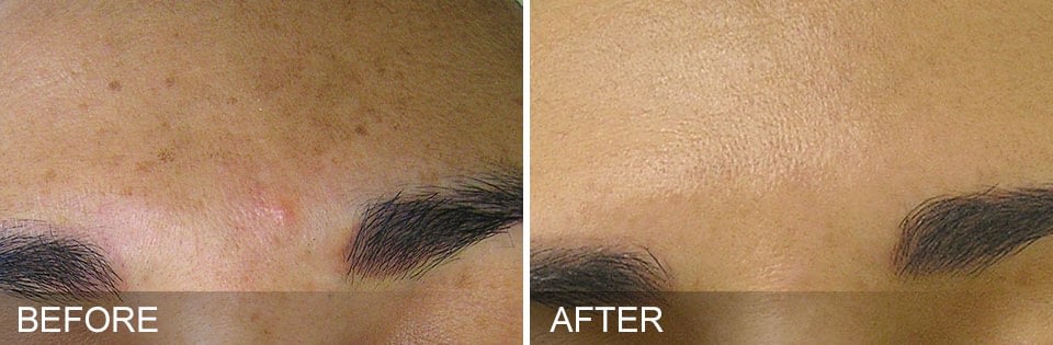 HYDRAFACIAL before after 3