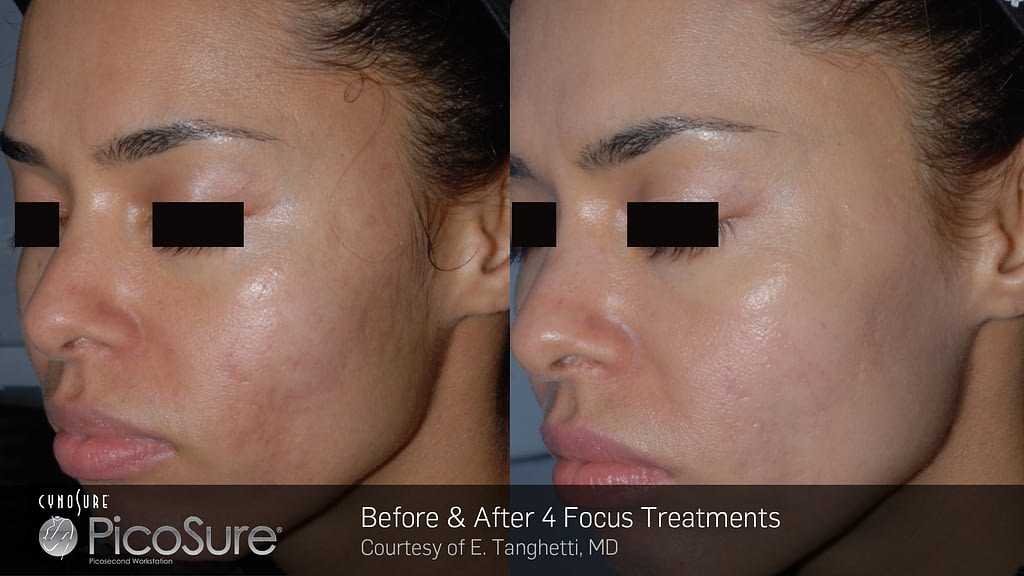 SKIN REVITALIZATION WITH PICOSURE 1