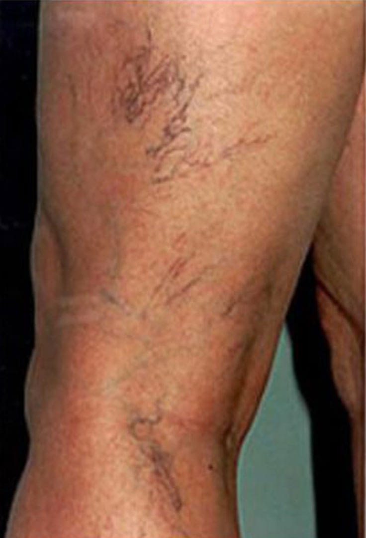 Laser for vascular before