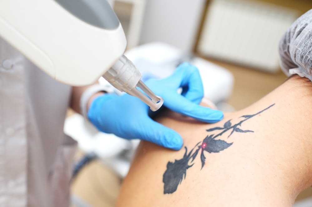 Laser Tattoo Removal Cost in Mississauga