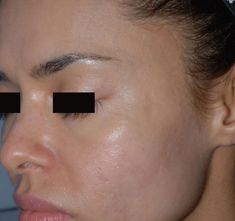 Skin Revitalization after