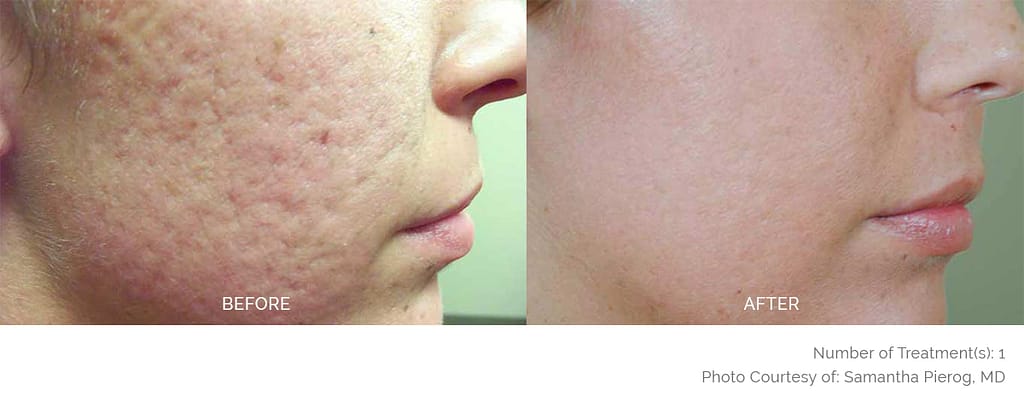 xeo rejuvenation ba 4