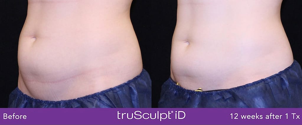 trusculpt id tummy2