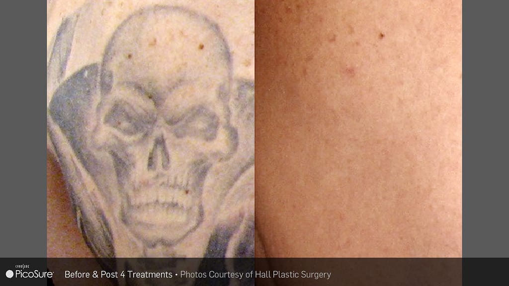 BA PIcosure HallPlasticSurgery Post4Tx