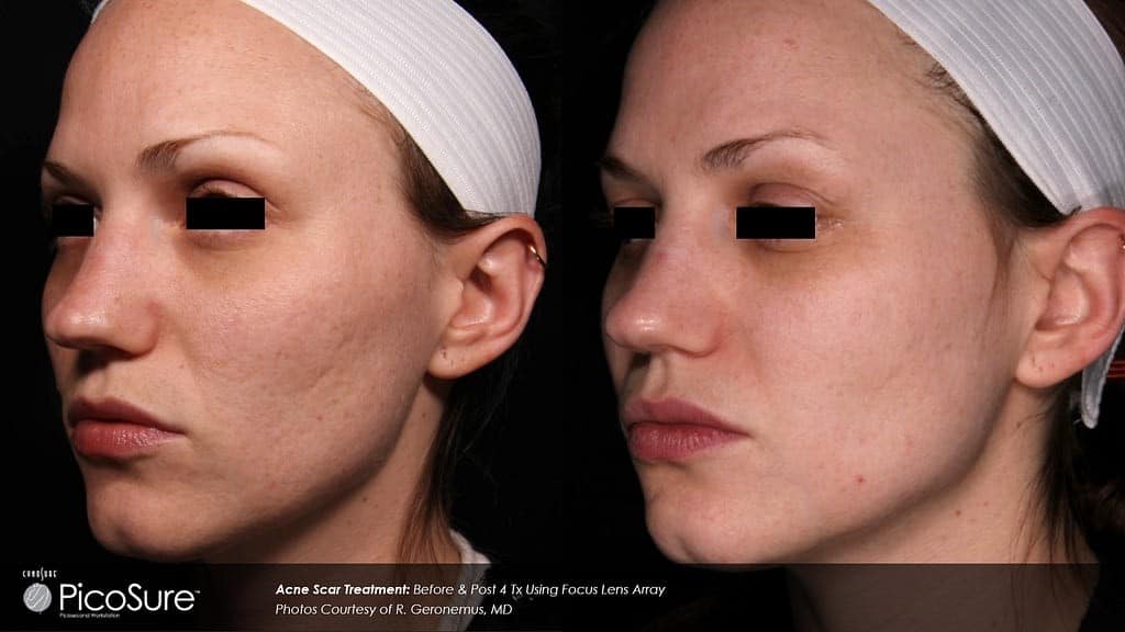Hyperpigmentation Treatment for Face