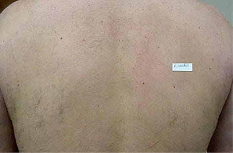 LASER HAIR REMOVAL AFTER