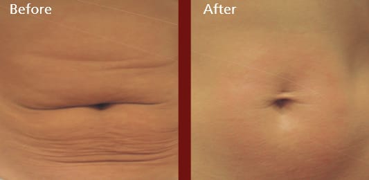 spa forma plus before and after belly