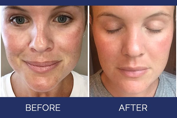 microneedling dermapen 1