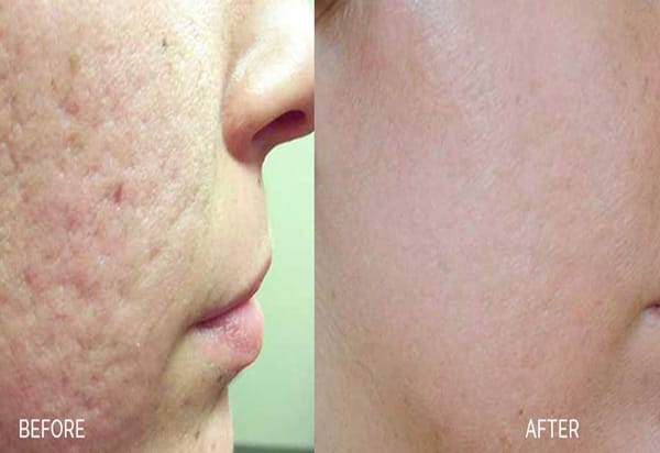 SKIN REJUVENATION WITH XEO x
