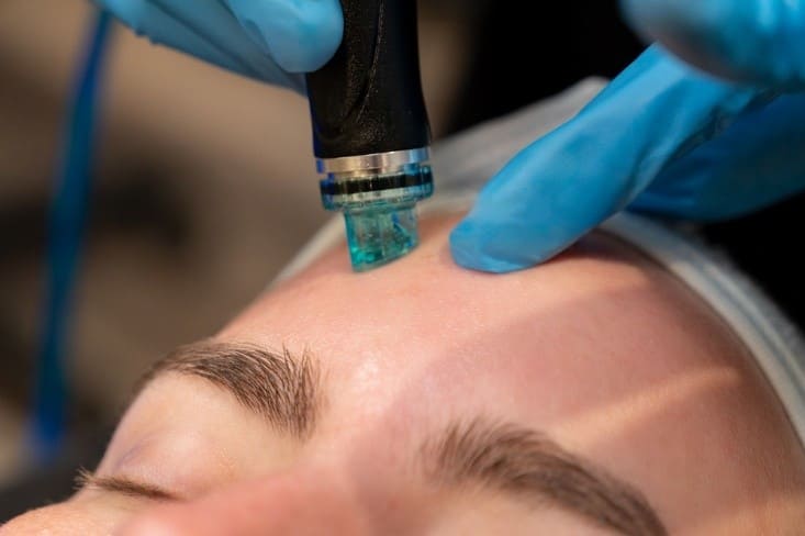 Best Laser Treatments for Acne in Mississauga