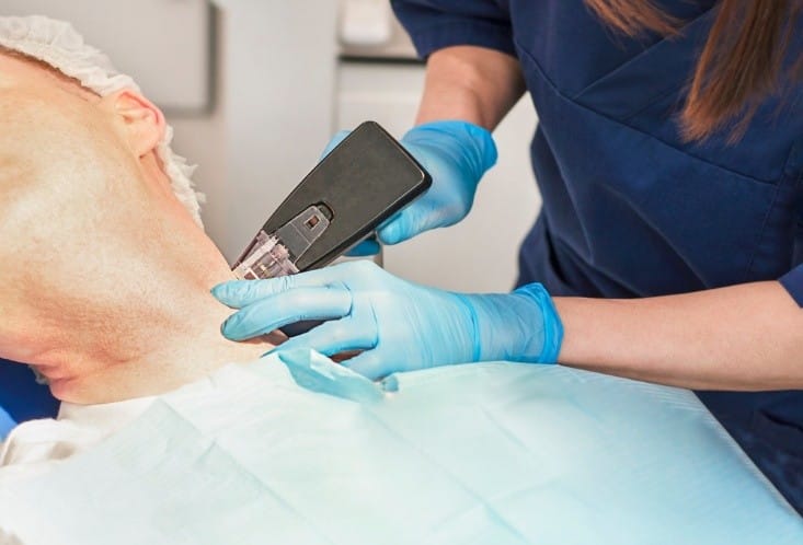 How Does Morpheus8 Improve Skin Tightening