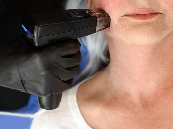 How Morpheus8 Face Treatment Rejuvenates Your Skin Naturally