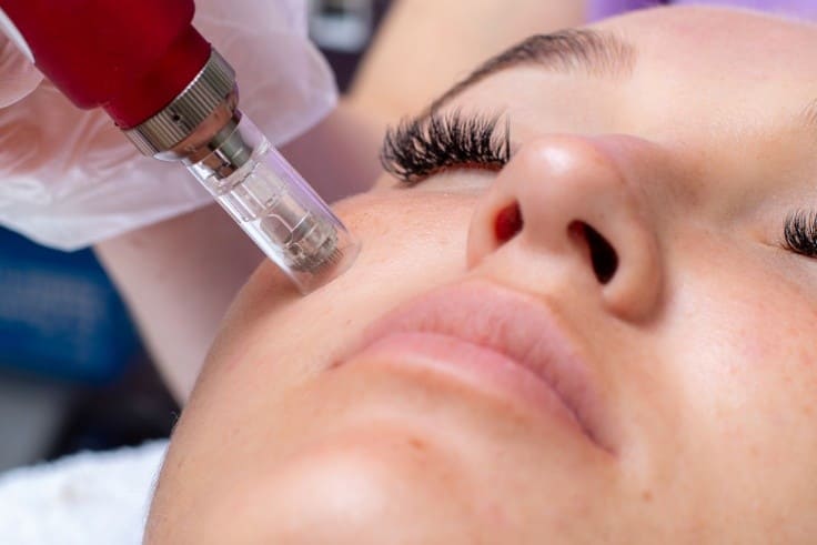 How Morpheus8 Microneedling Helps Tighten Loose Skin