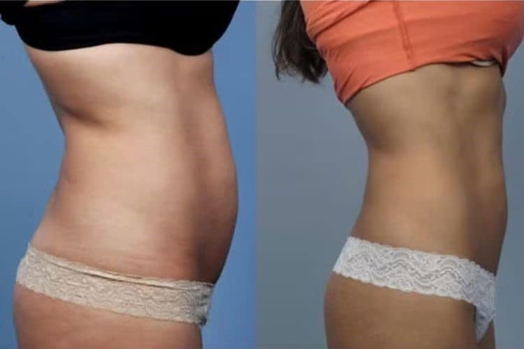Best Body Contouring