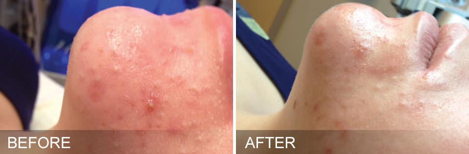 HYDRAFACIAL before after 1